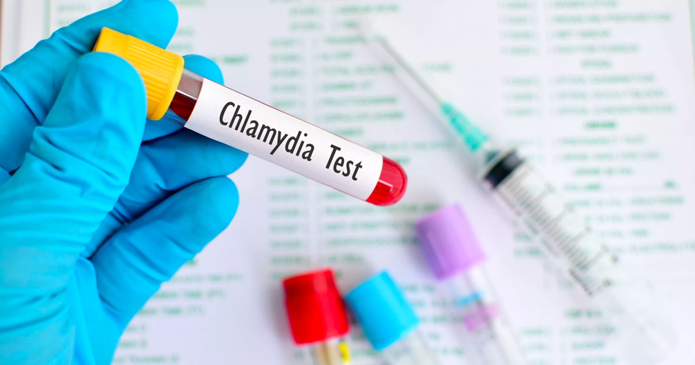 How to Test for Chlamydia in Females: Everything You Need to Know